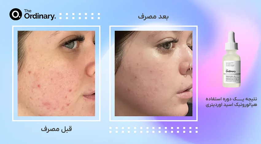 هیالورونیک اسید اوردینری